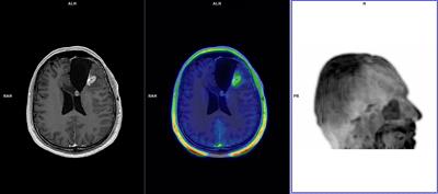 Diagnostic and Prognostic Potential of 18F-FET PET in the Differential Diagnosis of Glioma Recurrence and Treatment-Induced Changes After Chemoradiation Therapy